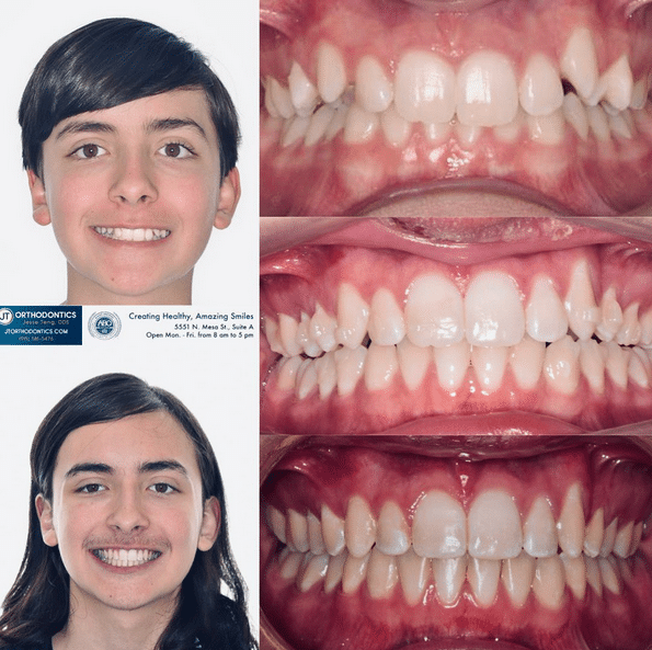 Teeth Transformation 13 JT Orthodontics in El Paso, TX