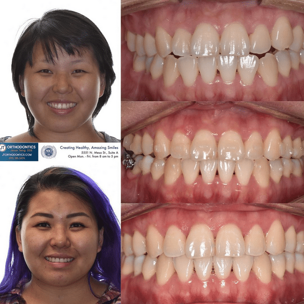 Teeth Transformation 6 JT Orthodontics in El Paso, TX