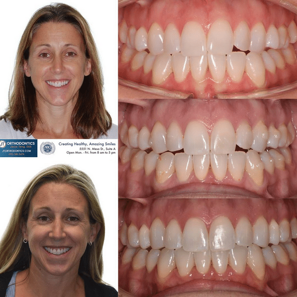 Teeth Transformation 5 JT Orthodontics in El Paso, TX