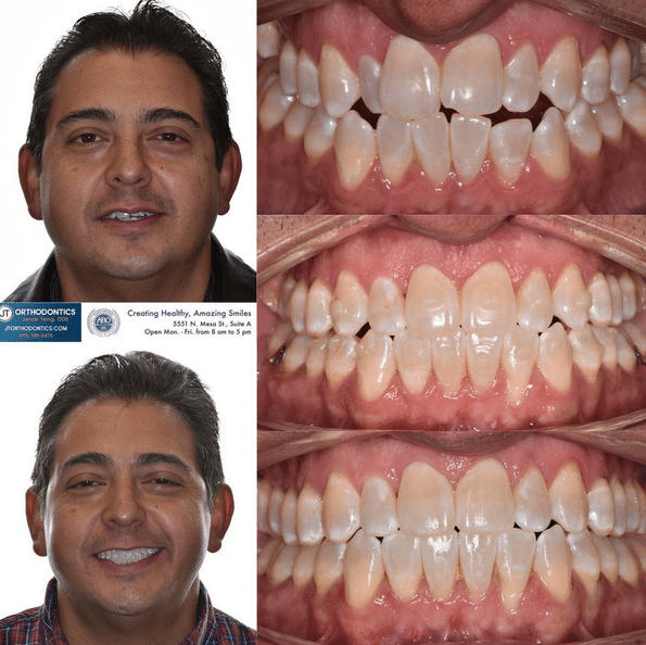Teeth Transformation 4 JT Orthodontics in El Paso, TX