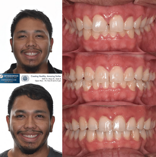 Teeth Transformation 3 JT Orthodontics in El Paso, TX