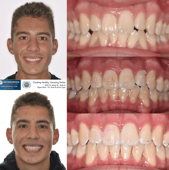 Teeth Transformation 2 JT Orthodontics in El Paso, TX