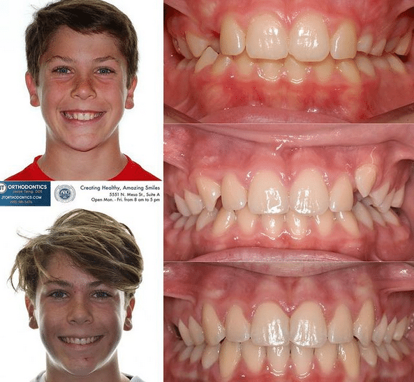 Teeth Transformation JT Orthodontics in El Paso, TX