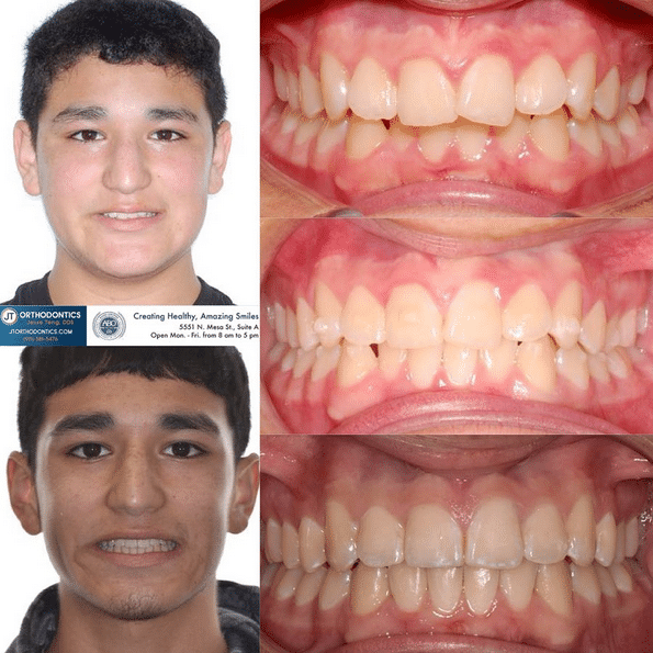 Teeth Transformation 8 JT Orthodontics in El Paso, TX