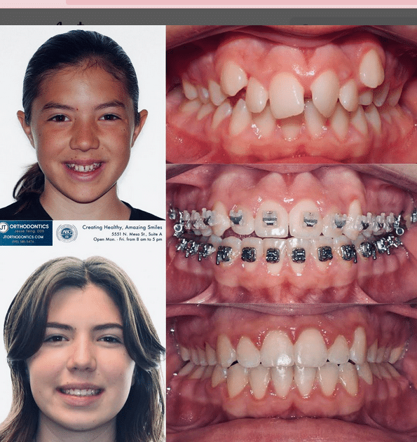 Teeth Transformation 12 JT Orthodontics in El Paso, TX