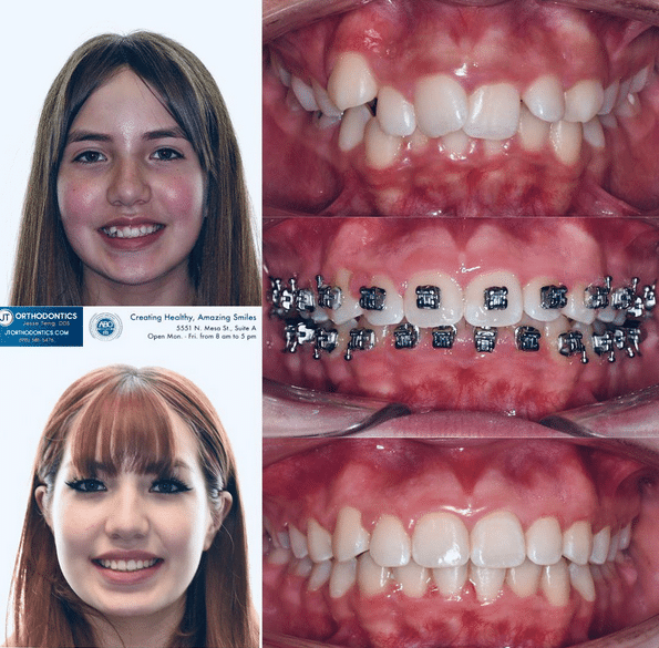 Teeth Transformation 11 JT Orthodontics in El Paso, TX