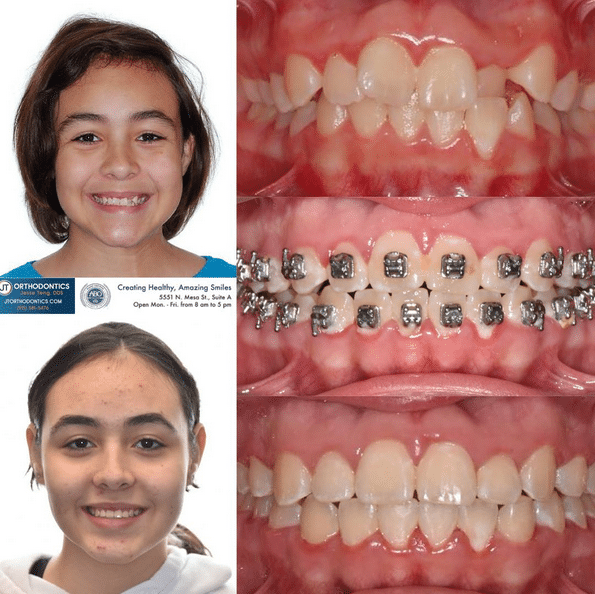 Teeth Transformation 16 JT Orthodontics in El Paso, TX