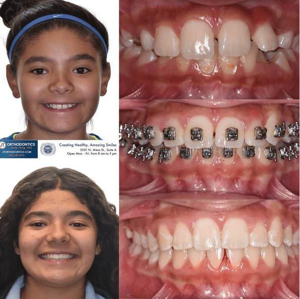 Teeth Transformation 15 JT Orthodontics in El Paso, TX