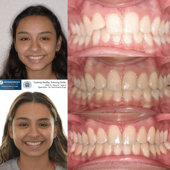 Teeth Transformation 14 JT Orthodontics in El Paso, TX