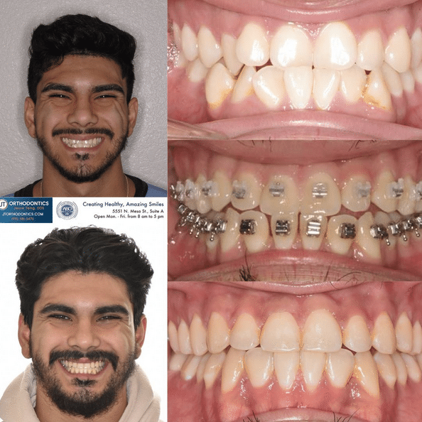 Teeth Transformation 14 JT Orthodontics in El Paso, TX